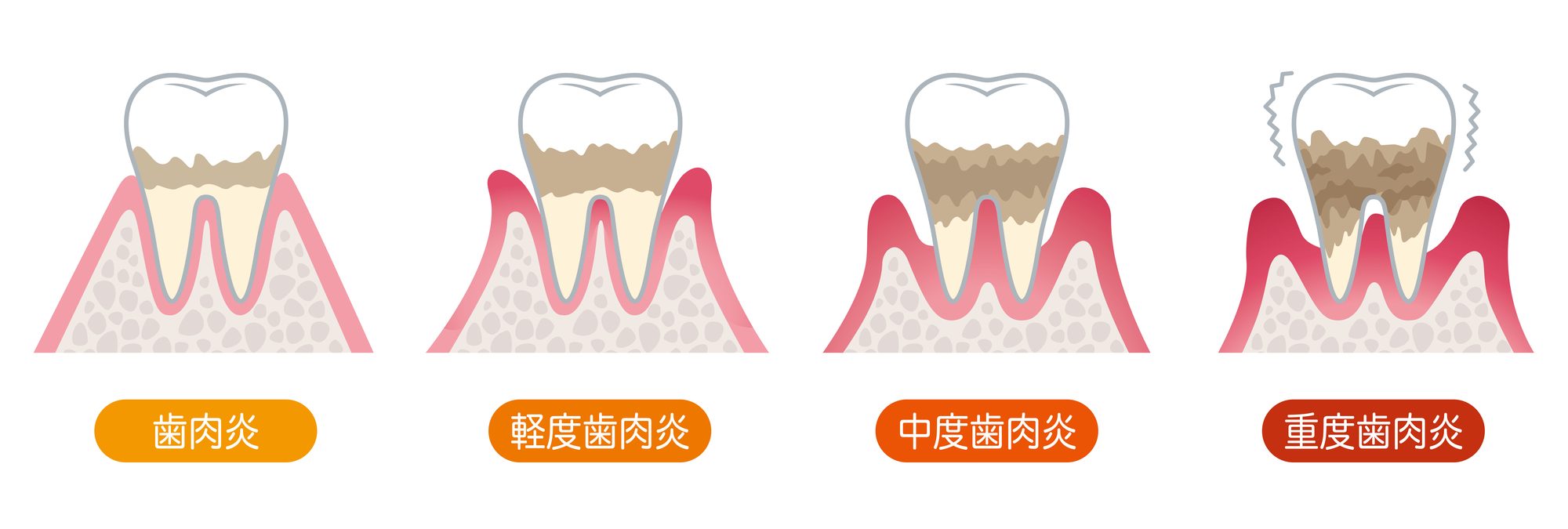 歯周病の進行